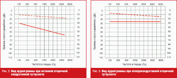 Функциональная тугоухость-1