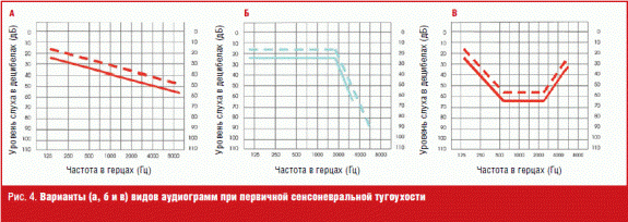 Функциональная тугоухость-2