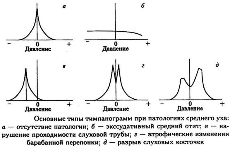Процедура тимпанометрии-1